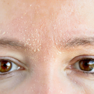 Middle-aged-caucasian-woman-with-dry-skin