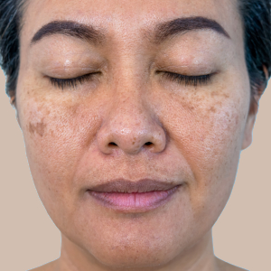 Middle-aged black woman with hyperpigmentation