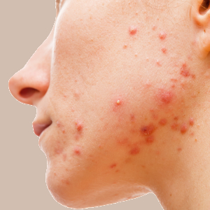 Young caucasian woman with acne