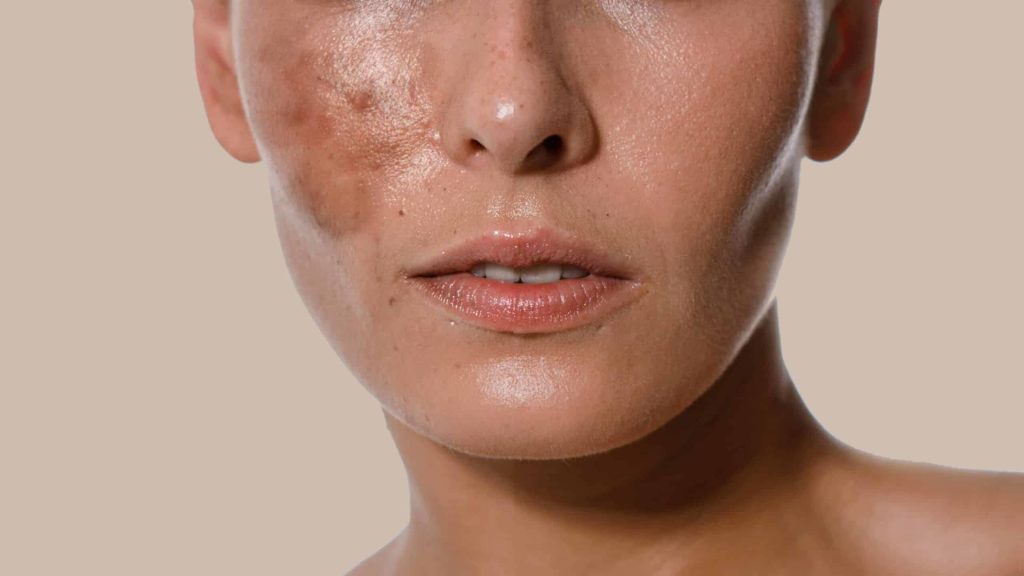 Middle-aged mixed-race woman before and after hyperpigmentation treatment on a beige background