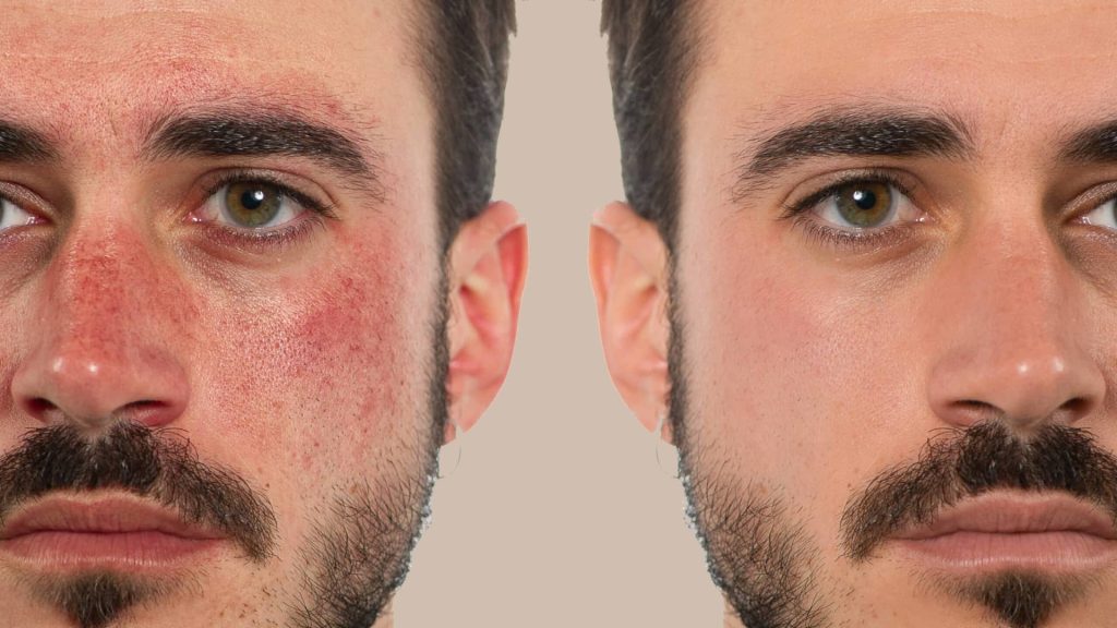 Young caucasian man before and after rosacea treatment on a beige background