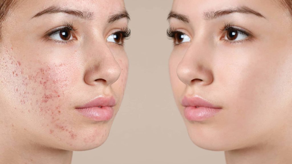 Young caucasian woman before and after acne treatment on a beige background