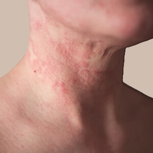 Eczema