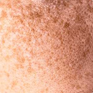 Hyperpigmentation close-up