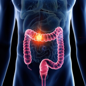 Inflammatory-bowel-disease