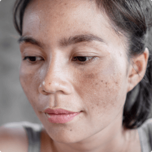 Middle-aged asian woman with hyperpigmentation