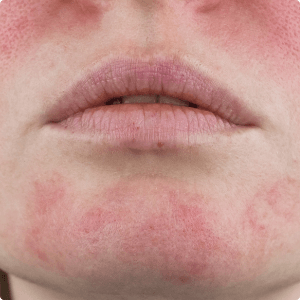 Middle-aged caucasian woman with rosacea (2)