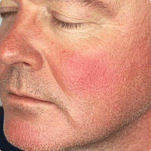 Middle-aged man with rosacea