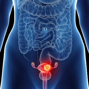 Polycystic-ovary-syndrome