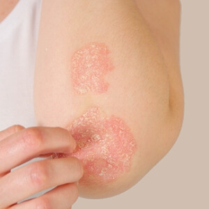 Psoriasis