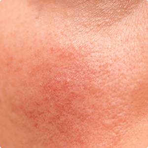 Rosacea close-up