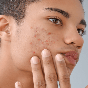 Young black man with acne