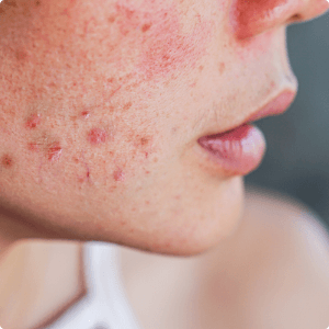 Young caucasian woman with acne (1)