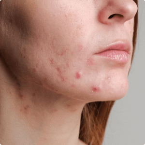 Young caucasian woman with acne (2)