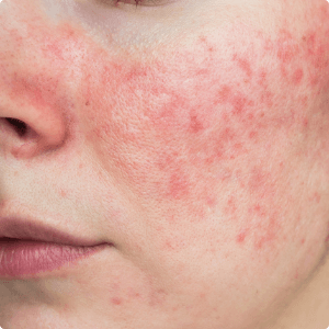 Young caucasian woman with rosacea